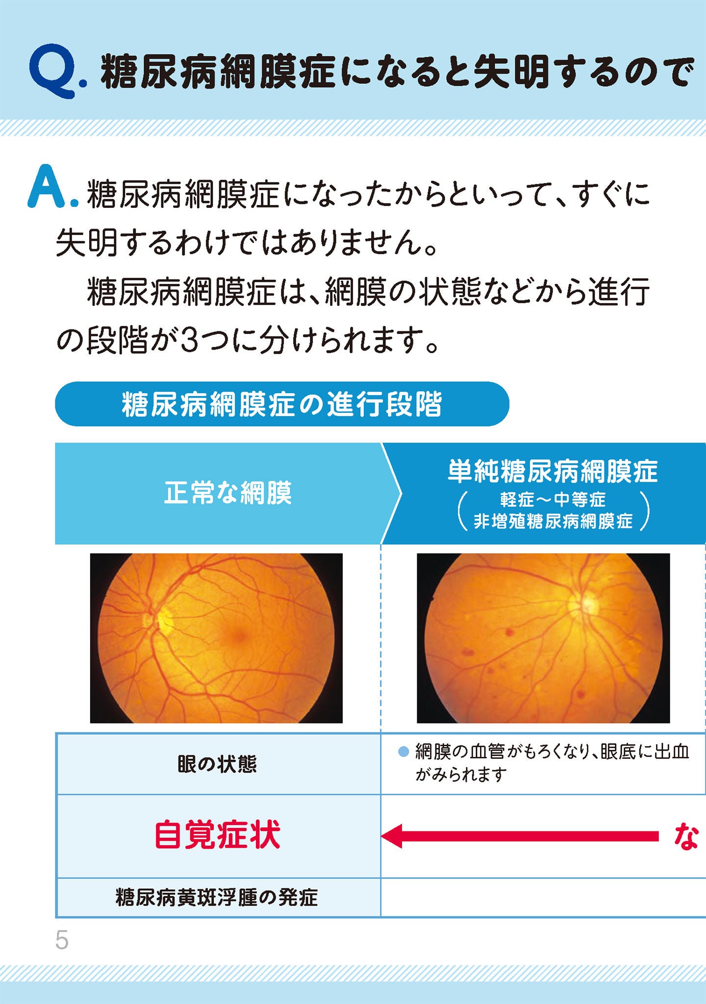 糖尿病網膜症になると失明するのですか？