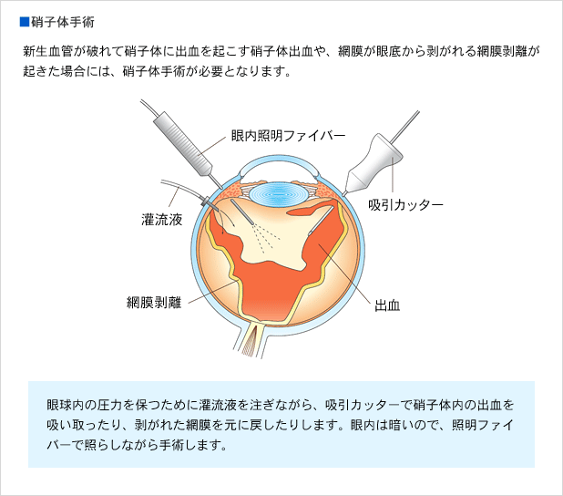 網膜剥離の主な治療法 | 参天製薬日本サイト