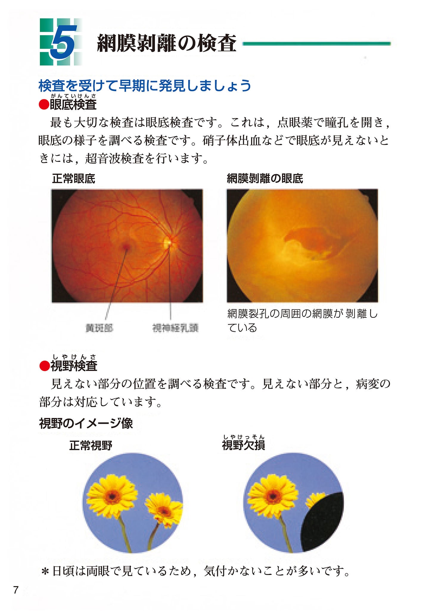 網膜剥離の検査